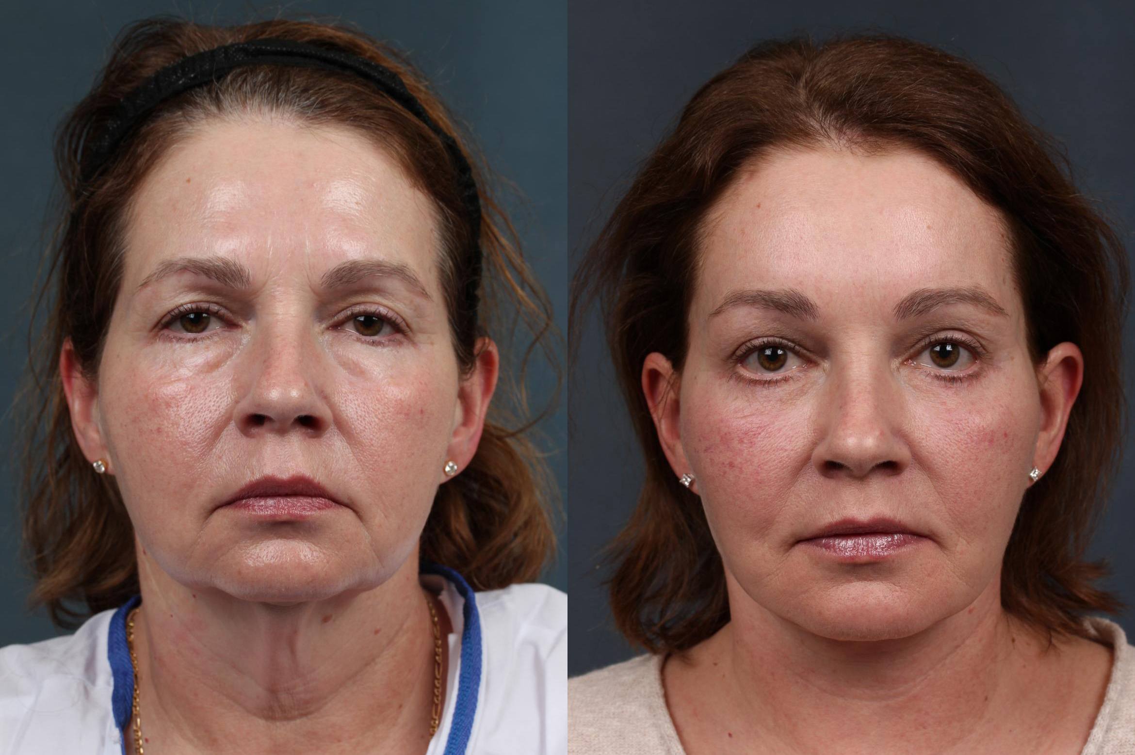 Facelift Case #281 Before and After Front View