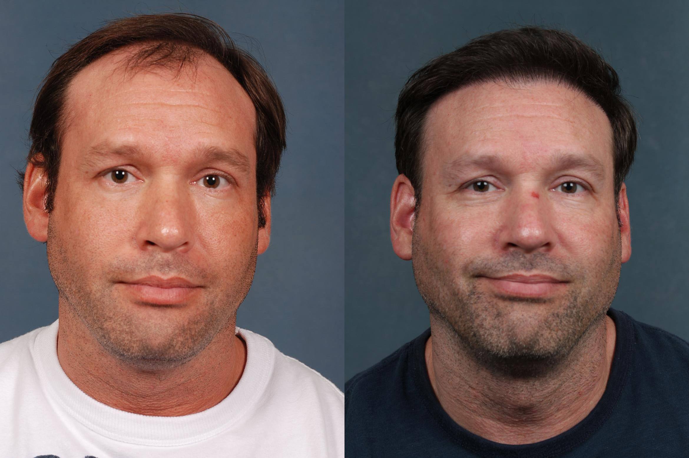 Hair Transplant Case #263 Before and After Front View