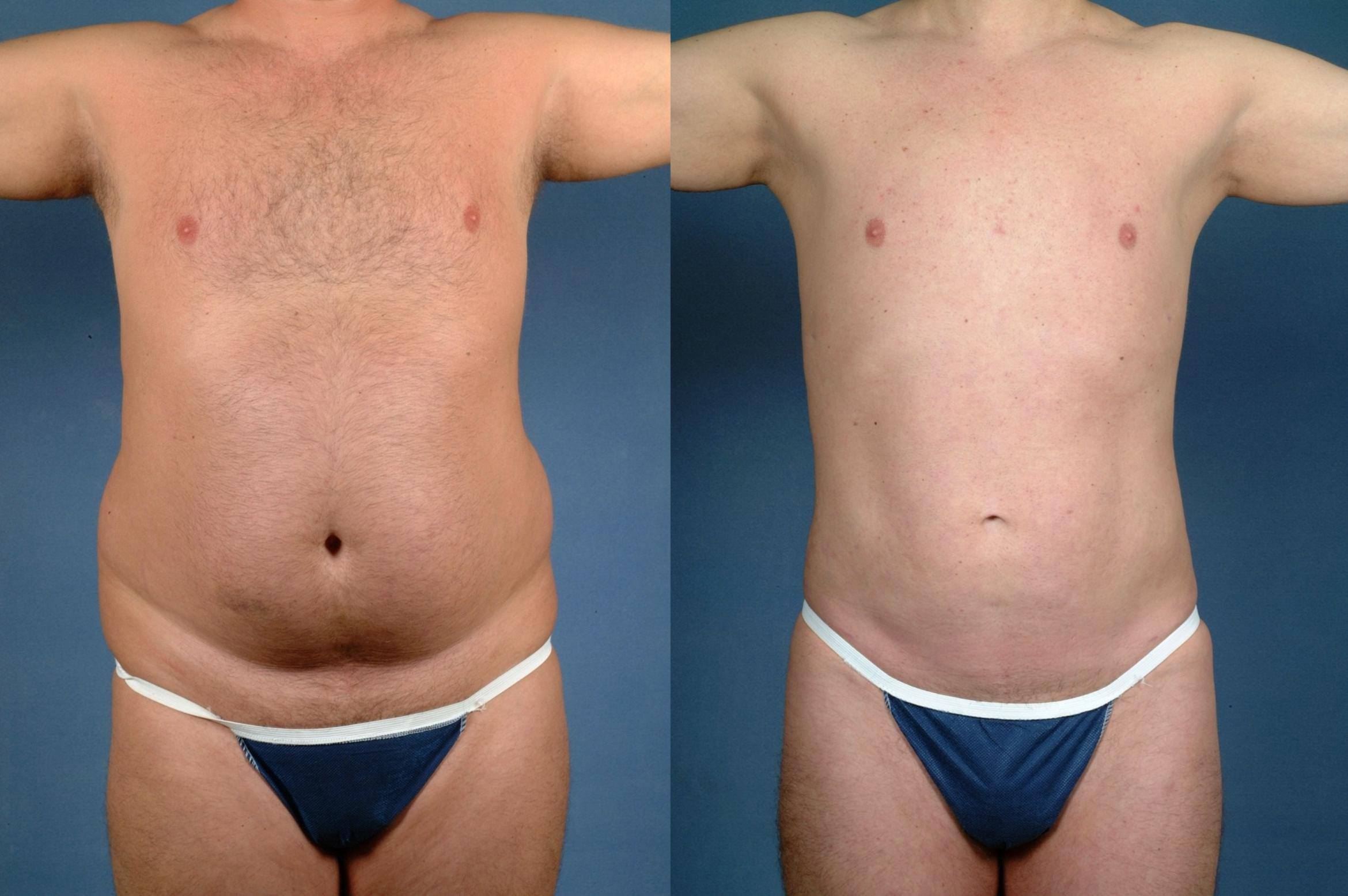 Liposuction for Men Case #722 Before and After Front View