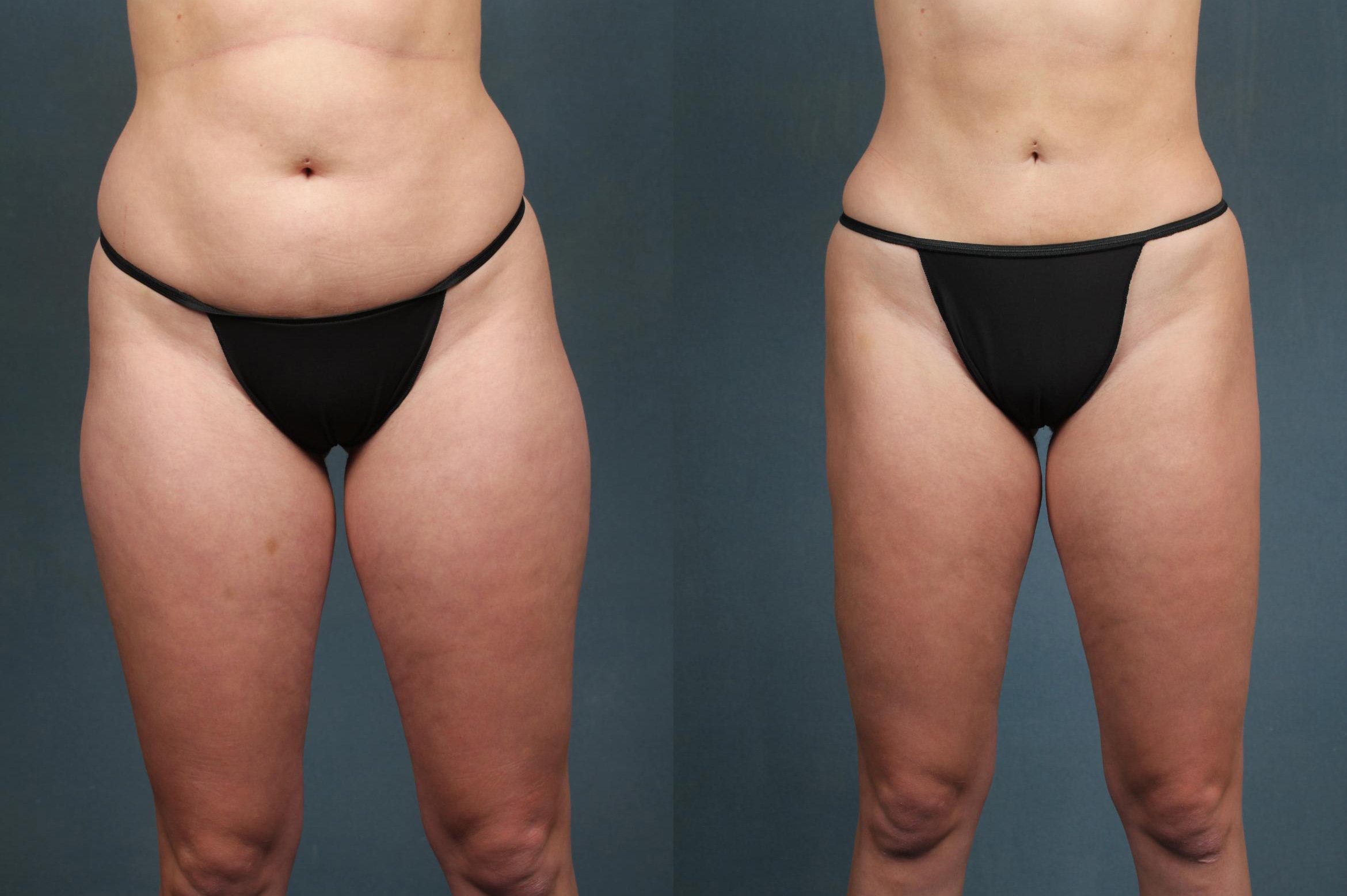 Liposuction for Women Case #593 Before and After Front View