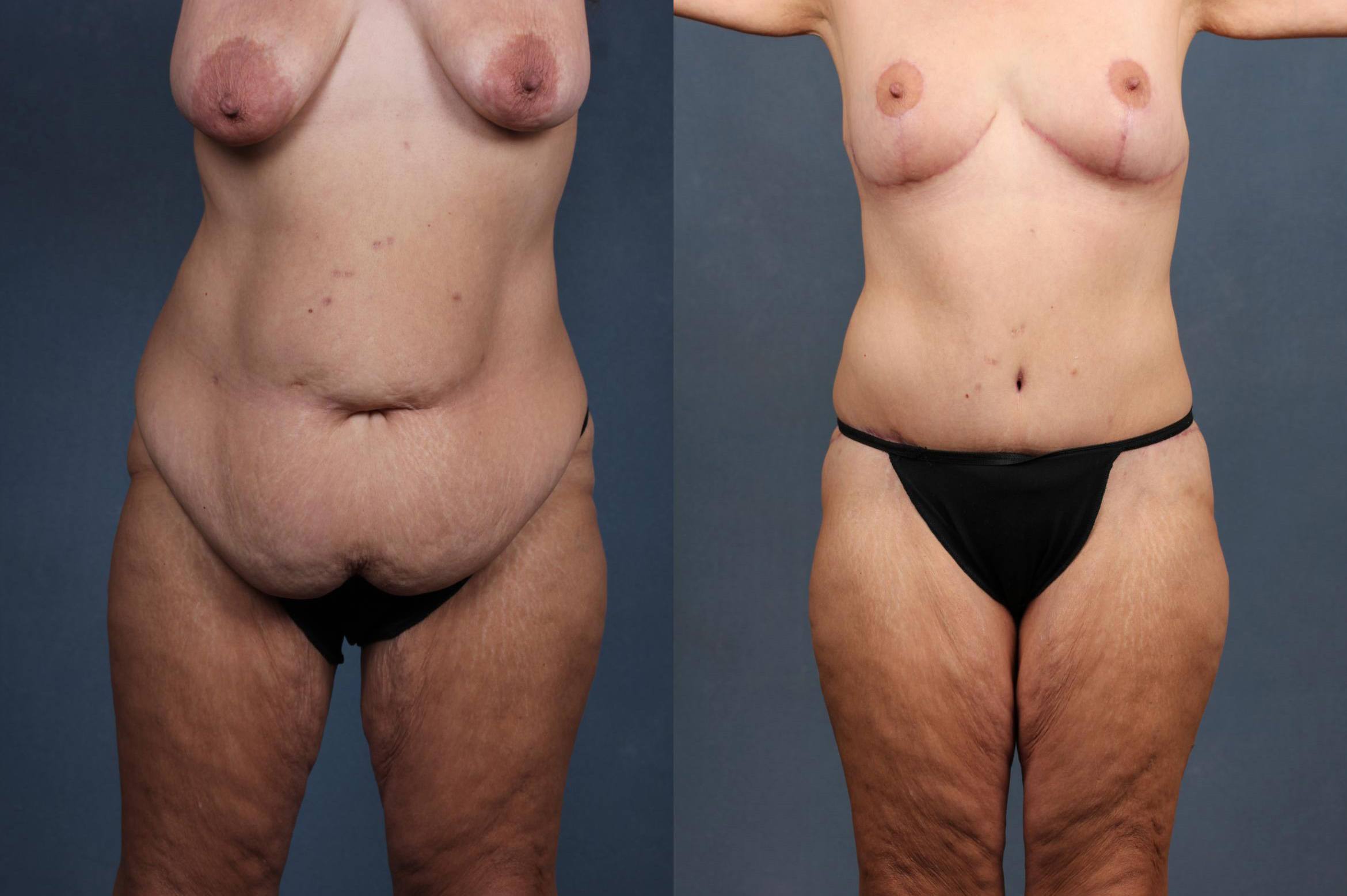 Tummy Tuck Case #567 Before and After Front View