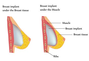 Implant Placement