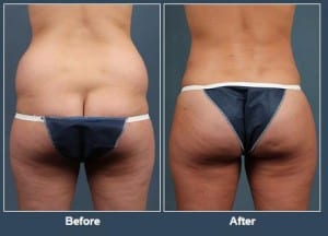 Louisville plastic surgeon discusses liposuction and fat transfer.