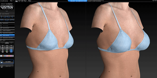 Vectra 3D Imaging provides breast augmentation patients in Louisville, KY, with a visual interpretation of what their results may look like.
