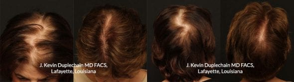 Neograft before and after images.