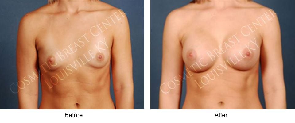 breast augmentation before-and-after photos