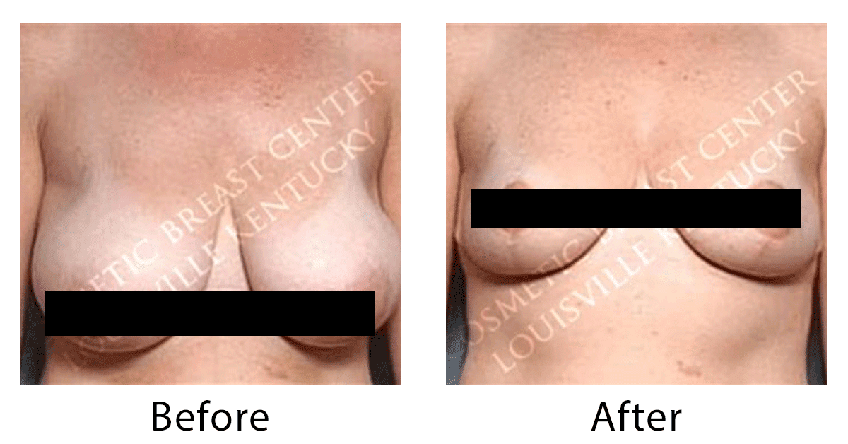 Why Breast Reduction In Louisville Ky Caloaesthetics Plastic Surgery