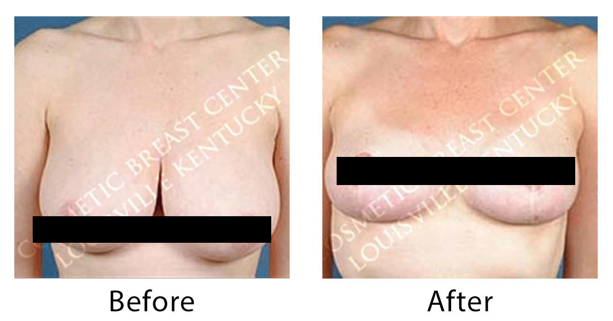 Why Breast Reduction in Louisville, KY
