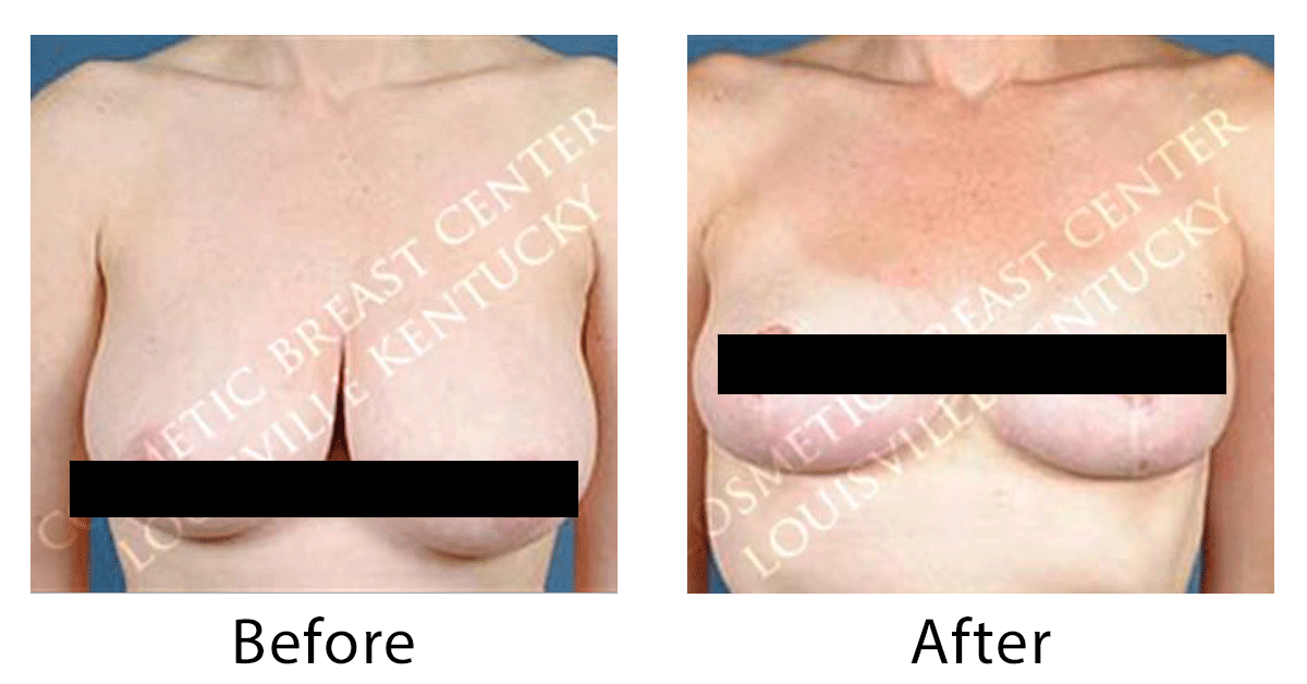 What size will I be after breast reduction?