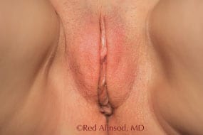 Vaginal Rejuvenation - ThermiVa - After