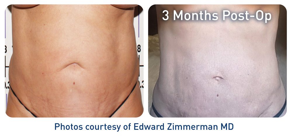 Renuvion before and after - abdomen